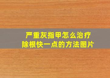 严重灰指甲怎么治疗除根快一点的方法图片