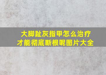 大脚趾灰指甲怎么治疗才能彻底断根呢图片大全