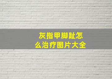 灰指甲脚趾怎么治疗图片大全