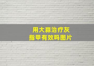 用大蒜治疗灰指甲有效吗图片