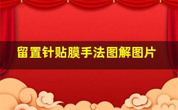 留置针贴膜手法图解图片