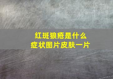 红斑狼疮是什么症状图片皮肤一片