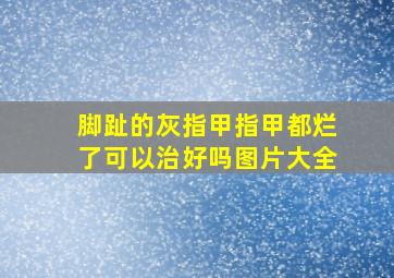 脚趾的灰指甲指甲都烂了可以治好吗图片大全