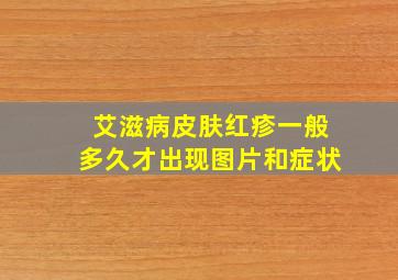 艾滋病皮肤红疹一般多久才出现图片和症状