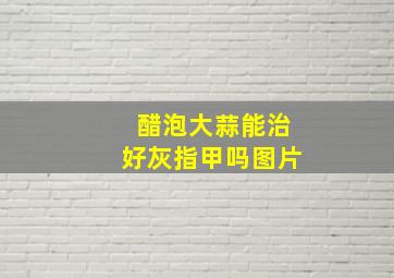 醋泡大蒜能治好灰指甲吗图片