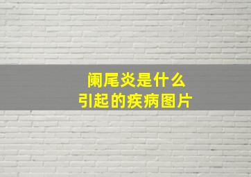 阑尾炎是什么引起的疾病图片