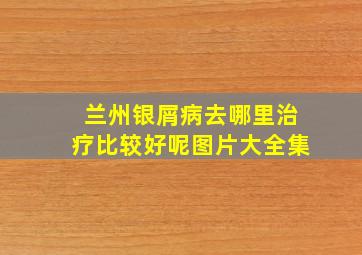 兰州银屑病去哪里治疗比较好呢图片大全集