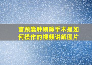 宫颈囊肿剔除手术是如何操作的视频讲解图片