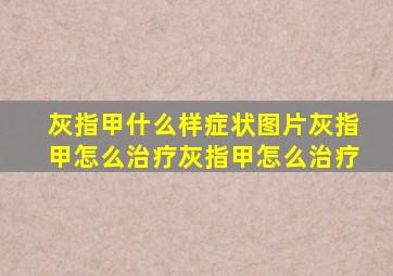 灰指甲什么样症状图片灰指甲怎么治疗灰指甲怎么治疗