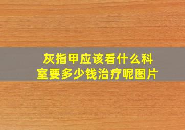 灰指甲应该看什么科室要多少钱治疗呢图片