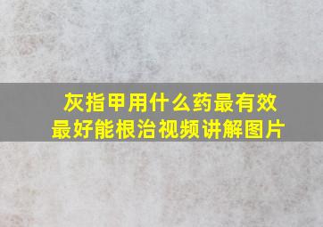 灰指甲用什么药最有效最好能根治视频讲解图片